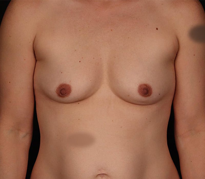Breast Augmentation Before & After Gallery - Patient 403564 - Image 1