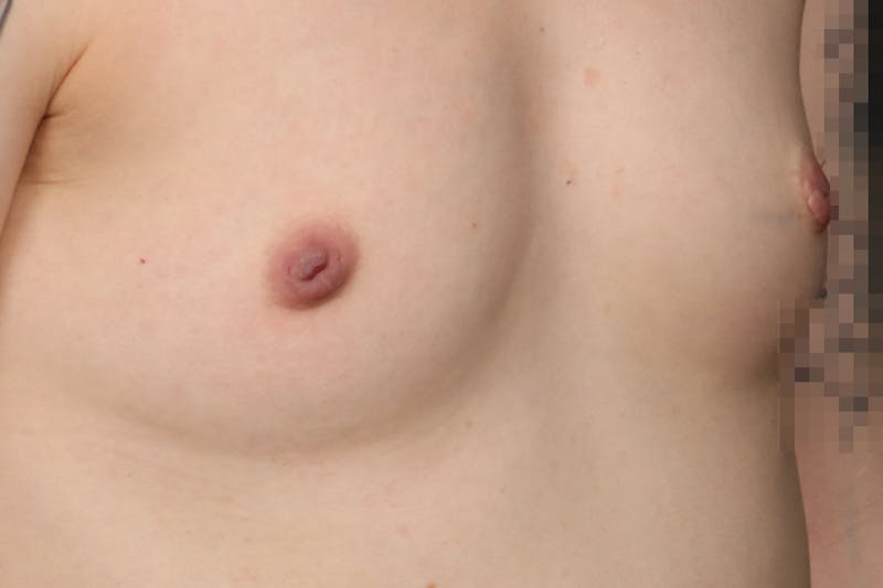 Inverted Nipple Repair Before & After Gallery - Patient 307066 - Image 3
