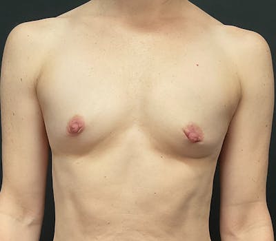 Breast Augmentation Before & After Gallery - Patient 137851 - Image 1