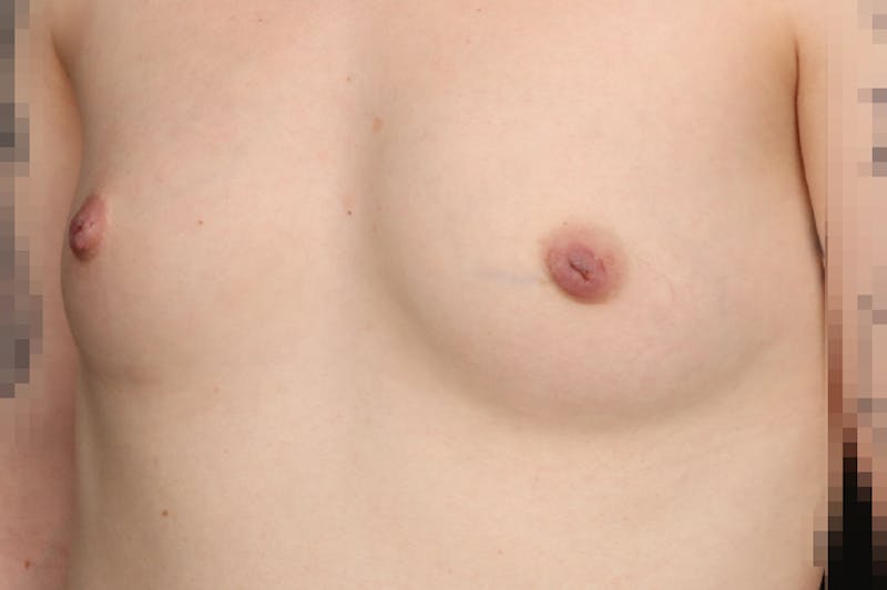 Inverted Nipple Repair Before & After Gallery - Patient 307066 - Image 5