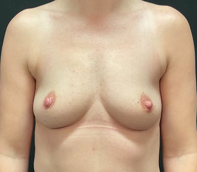 Breast Augmentation Before & After Gallery - Patient 273492 - Image 1