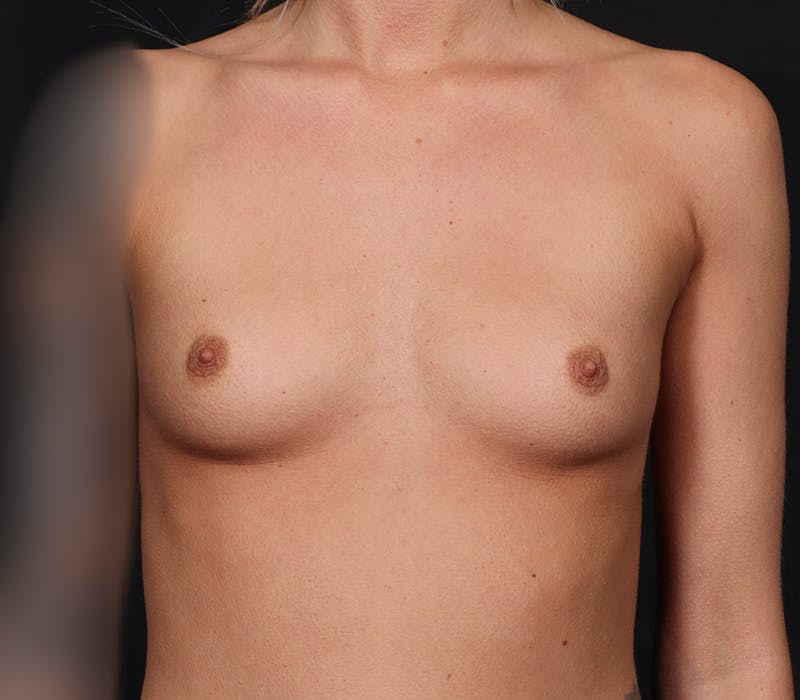 Breast Augmentation Before & After Gallery - Patient 276157 - Image 1