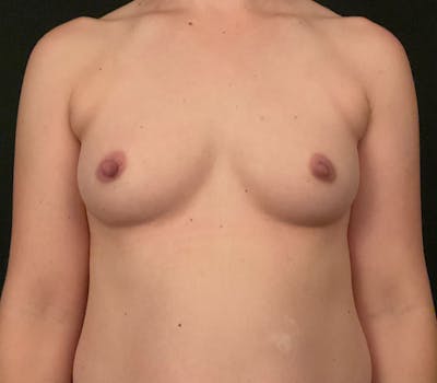Breast Augmentation Before & After Gallery - Patient 199033 - Image 1