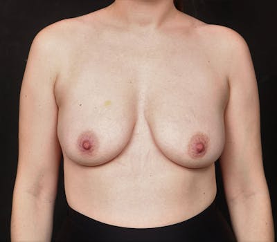 Breast Augmentation Before & After Gallery - Patient 254493 - Image 1