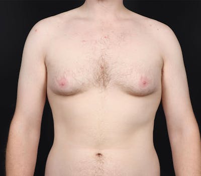 Gynecomastia Before & After Gallery - Patient 130049 - Image 1