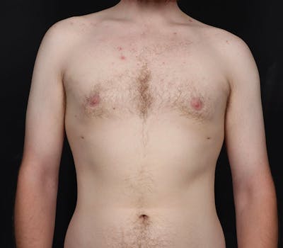 Gynecomastia Before & After Gallery - Patient 130049 - Image 2