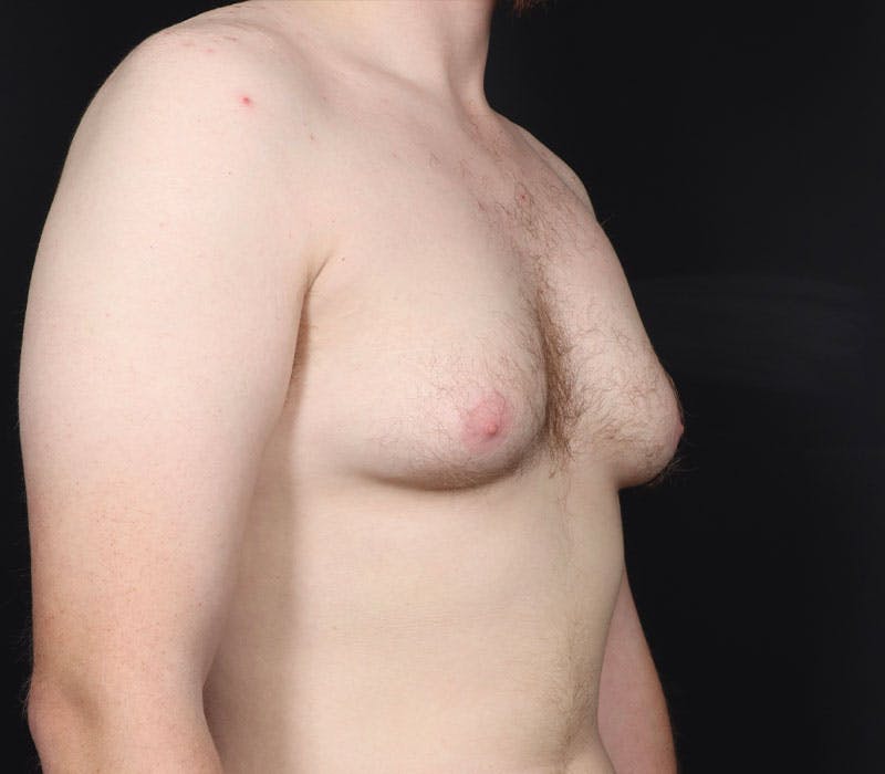 Gynecomastia Before & After Gallery - Patient 130049 - Image 3
