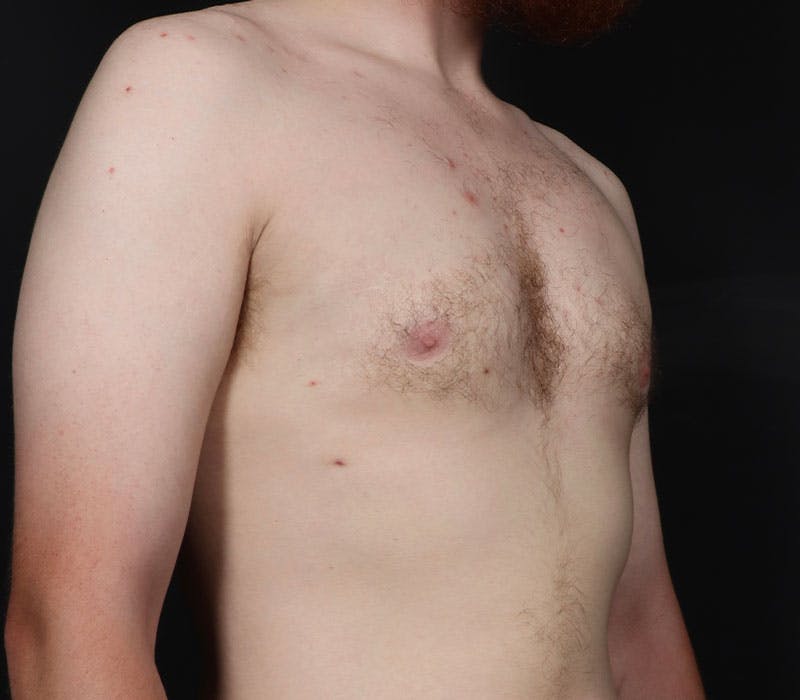 Gynecomastia Before & After Gallery - Patient 130049 - Image 4