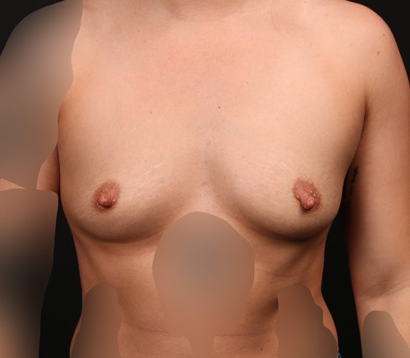 Breast Augmentation Before & After Gallery - Patient 876892 - Image 1