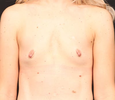 Breast Augmentation Before & After Gallery - Patient 364383 - Image 1