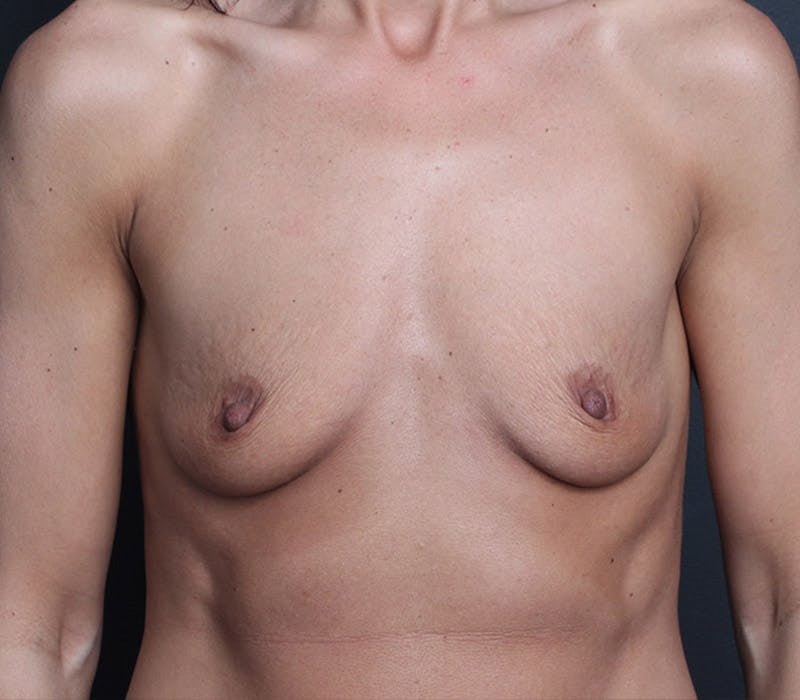 Breast Augmentation Before & After Gallery - Patient 123203 - Image 1