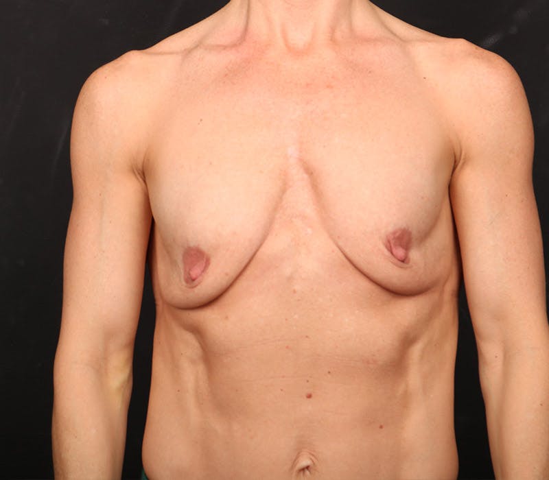 Breast Augmentation Before & After Gallery - Patient 713366 - Image 1