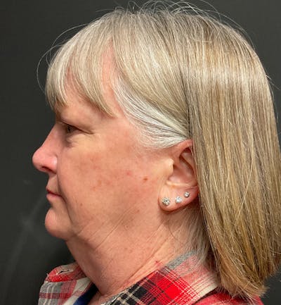 Face and Neck Lift Before & After Gallery - Patient 203466 - Image 1