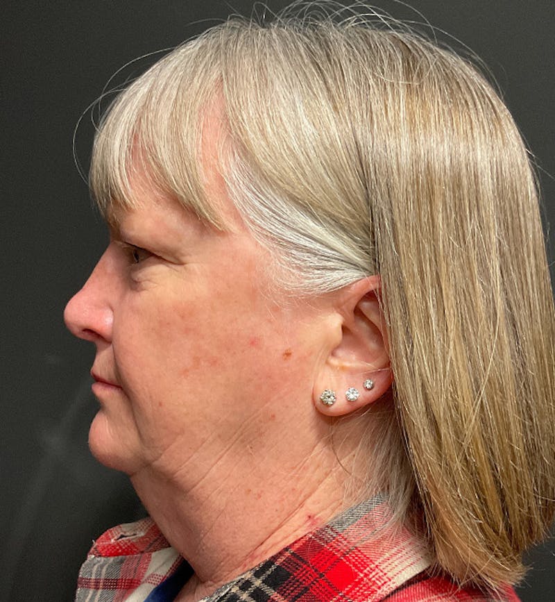 Face and Neck Lift Before & After Gallery - Patient 203466 - Image 1