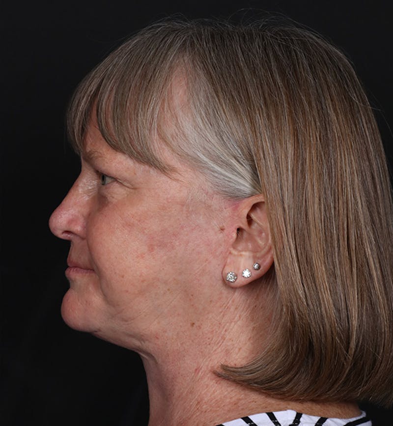 Face and Neck Lift Before & After Gallery - Patient 203466 - Image 2