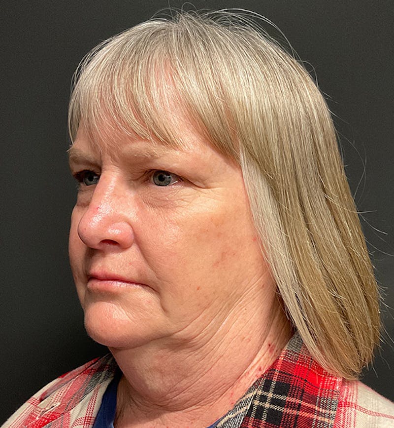 Face and Neck Lift Before & After Gallery - Patient 203466 - Image 3