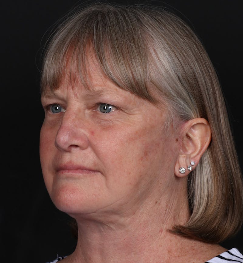 Face and Neck Lift Before & After Gallery - Patient 203466 - Image 4