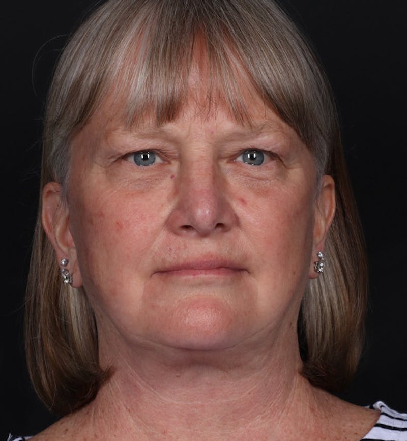 Face and Neck Lift Before & After Gallery - Patient 203466 - Image 6