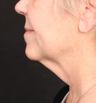 Face and Neck Lift Before & After Gallery - Patient 113640 - Image 1