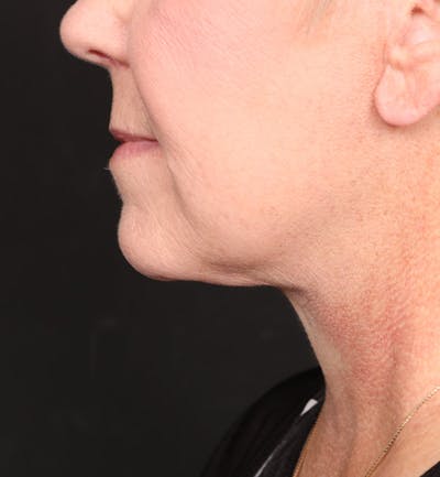 Face and Neck Lift Before & After Gallery - Patient 113640 - Image 2