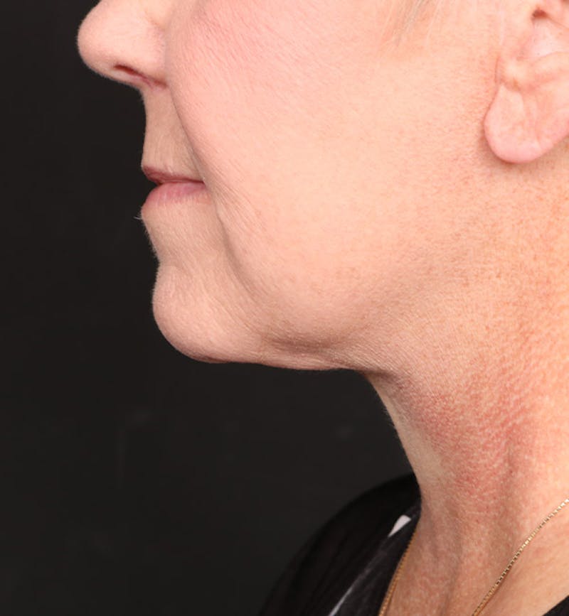 Face and Neck Lift Before & After Gallery - Patient 113640 - Image 2