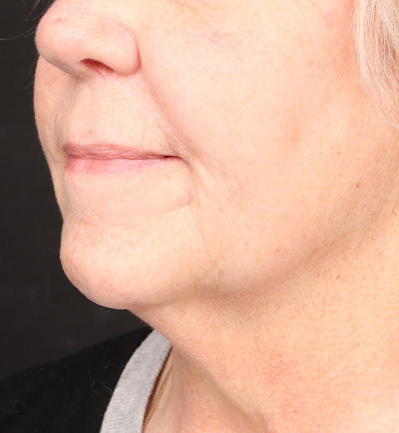 Face and Neck Lift Before & After Gallery - Patient 113640 - Image 3