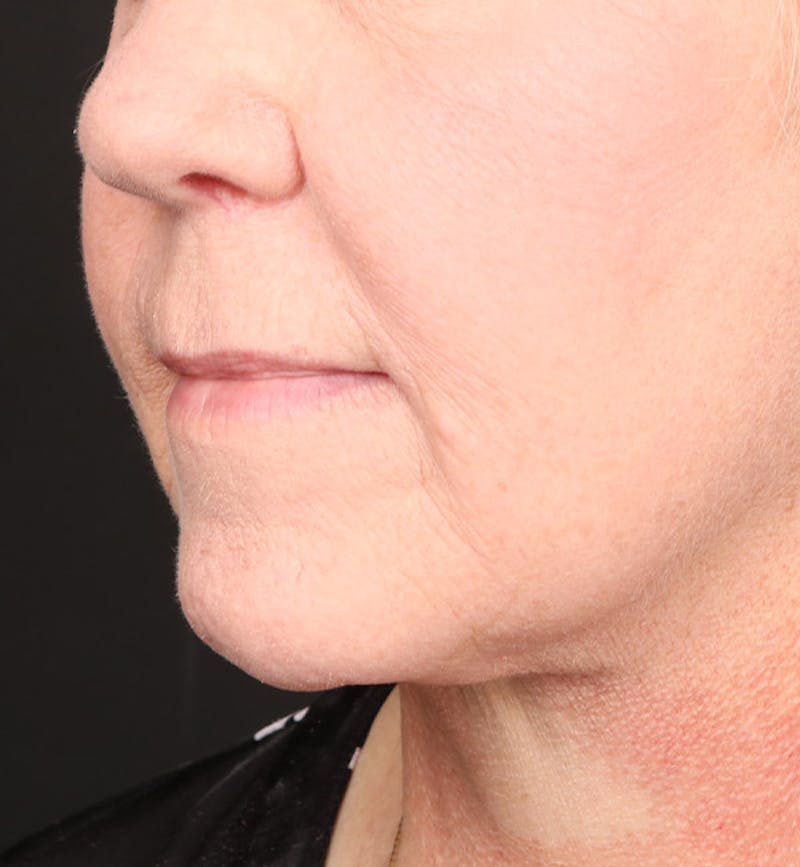 Face and Neck Lift Before & After Gallery - Patient 113640 - Image 4