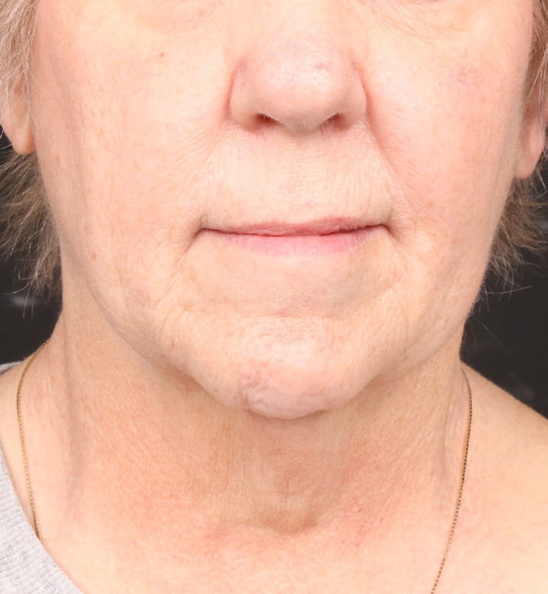 Face and Neck Lift Before & After Gallery - Patient 113640 - Image 5