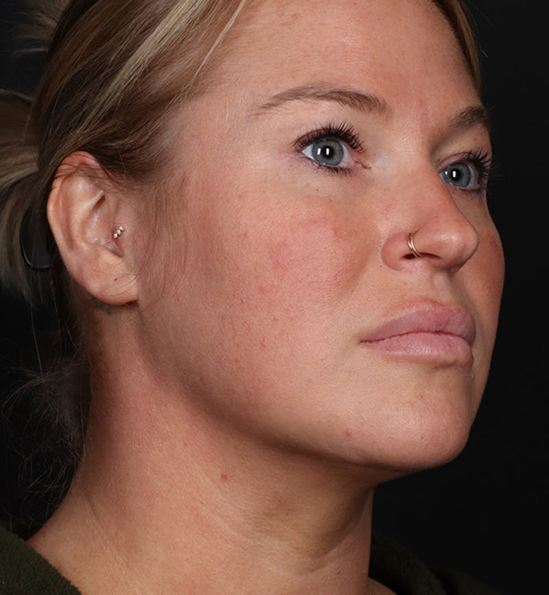 Deep Neck Lift Before & After Gallery - Patient 347956 - Image 2