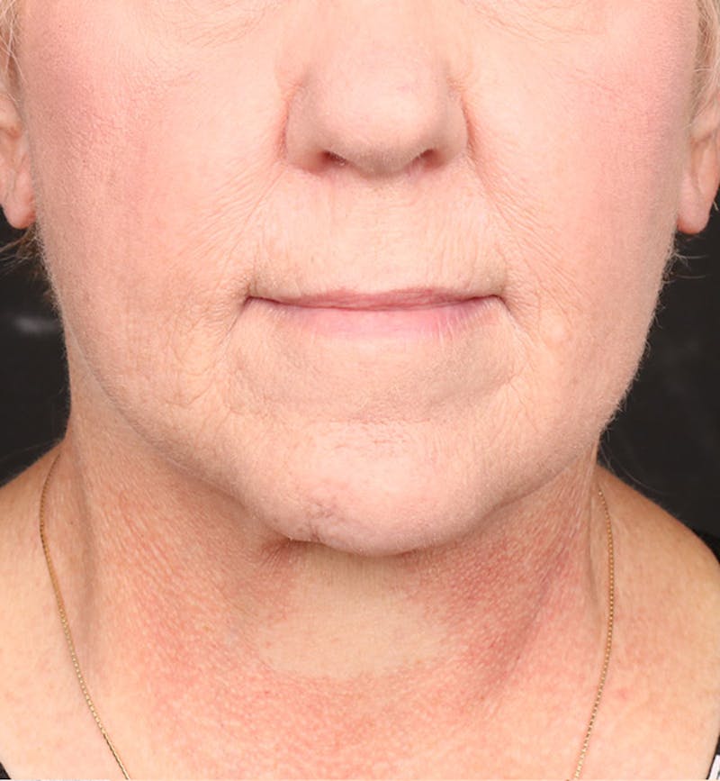Face and Neck Lift Before & After Gallery - Patient 113640 - Image 6