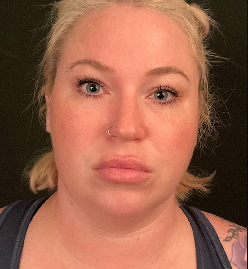 Deep Neck Lift Before & After Gallery - Patient 347956 - Image 3
