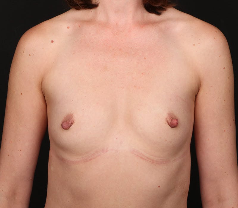 Breast Augmentation Before & After Gallery - Patient 326916 - Image 1