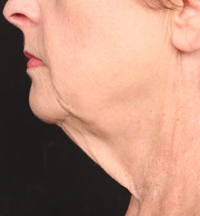 Face and Neck Lift Before & After Gallery - Patient 184172 - Image 1