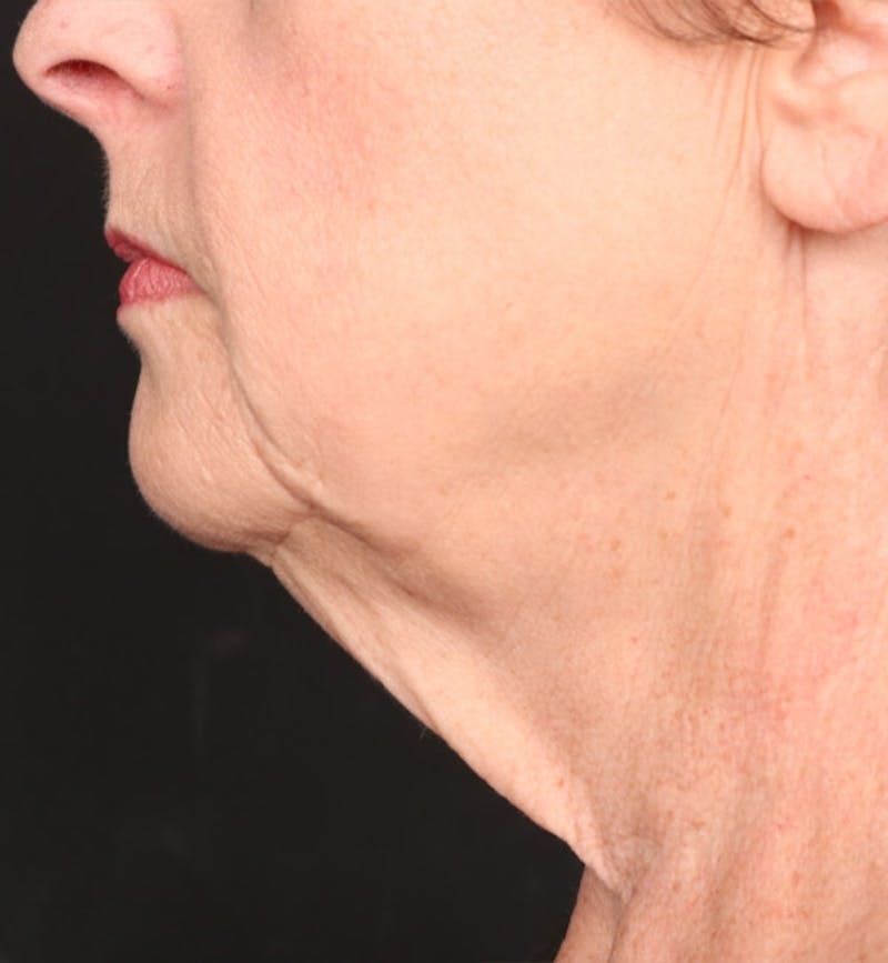 Face and Neck Lift Before & After Gallery - Patient 184172 - Image 1
