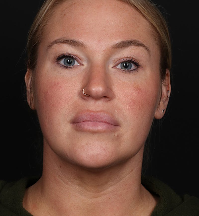 Deep Neck Lift Before & After Gallery - Patient 347956 - Image 4