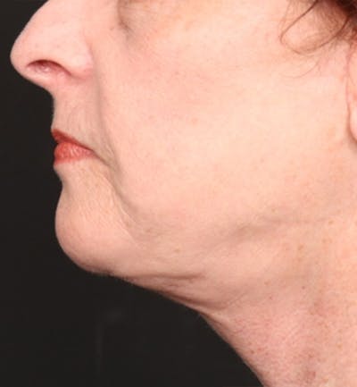 Face and Neck Lift Before & After Gallery - Patient 184172 - Image 2