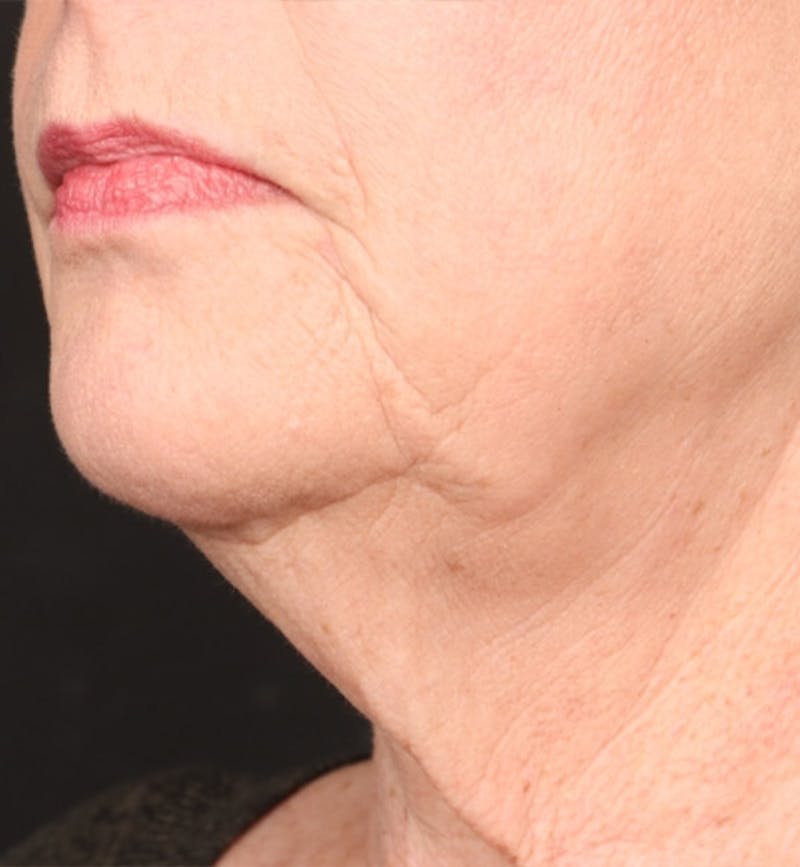 Face and Neck Lift Before & After Gallery - Patient 184172 - Image 3