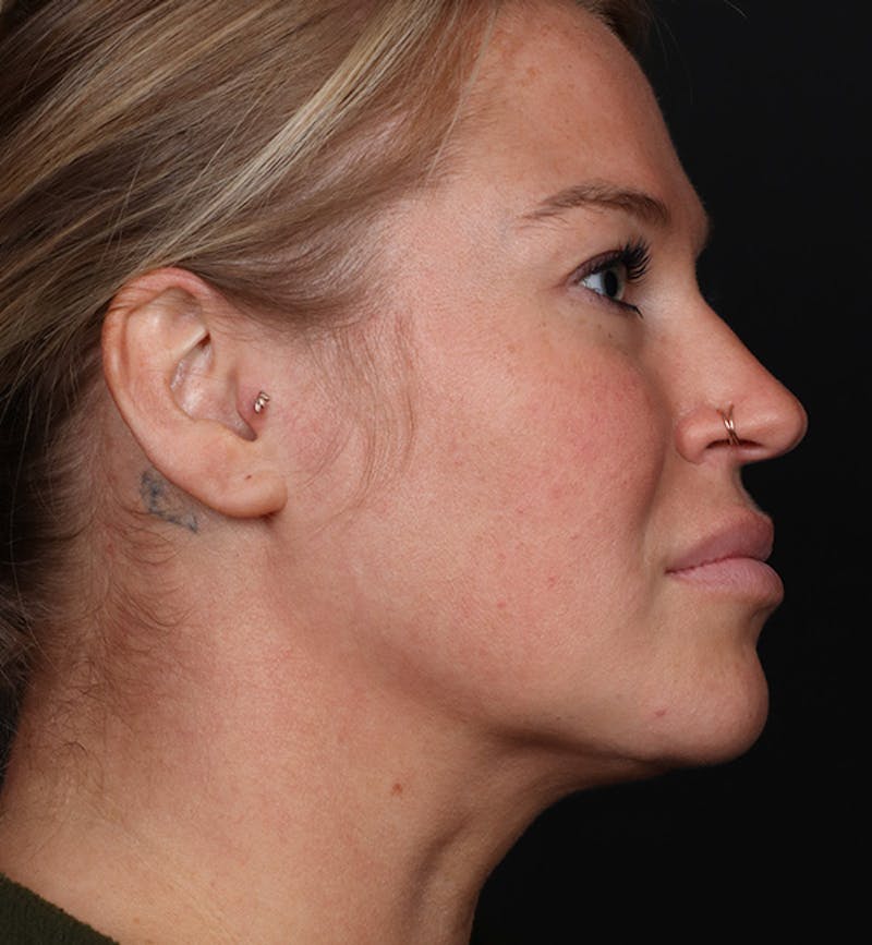Deep Neck Lift Before & After Gallery - Patient 347956 - Image 6