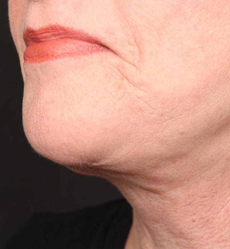 Face and Neck Lift Before & After Gallery - Patient 184172 - Image 4
