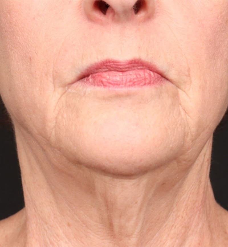 Face and Neck Lift Before & After Gallery - Patient 184172 - Image 5