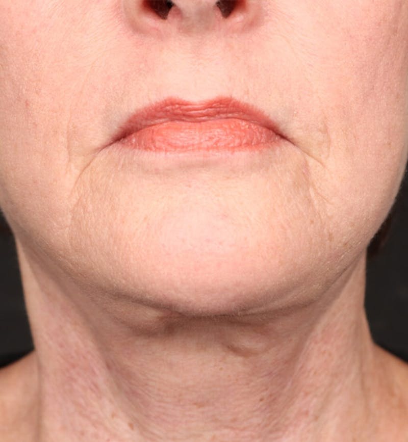 Face and Neck Lift Before & After Gallery - Patient 184172 - Image 6