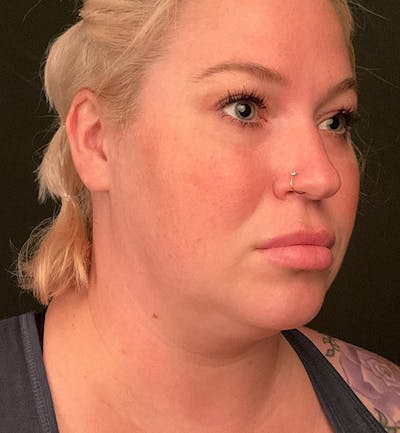 Buccal Fat Removal Before & After Gallery - Patient 168120 - Image 1