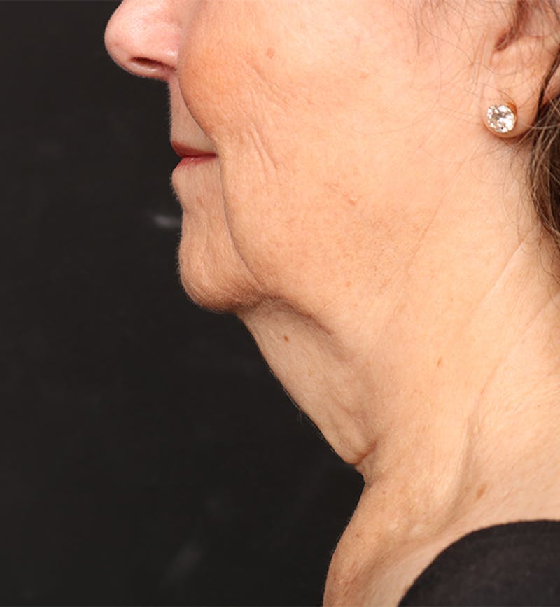 Face and Neck Lift Before & After Gallery - Patient 380422 - Image 1