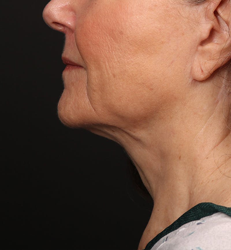 Face and Neck Lift Before & After Gallery - Patient 380422 - Image 2
