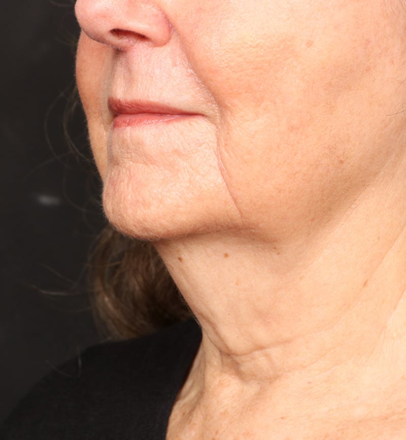 Face and Neck Lift Before & After Gallery - Patient 380422 - Image 3