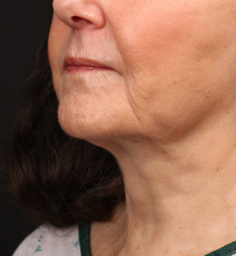 Face and Neck Lift Before & After Gallery - Patient 380422 - Image 4