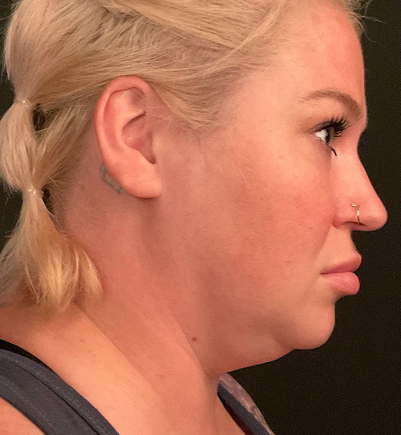Buccal Fat Removal Before & After Gallery - Patient 168120 - Image 5