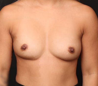 Breast Augmentation Before & After Gallery - Patient 109295 - Image 1