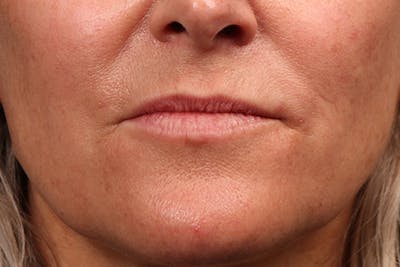 Injectables Before & After Gallery - Patient 322516 - Image 1