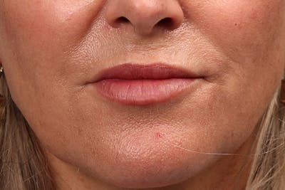 Injectables Before & After Gallery - Patient 322516 - Image 2